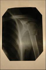 Ружена до лечения