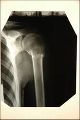 Ружена после лечения